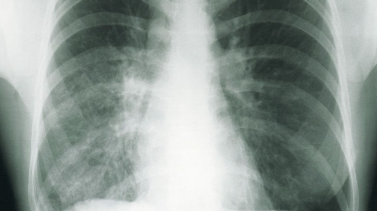 WHO: Počet úmrtí na tuberkulózu poprvé za více než deset let vzrostl